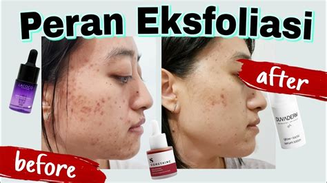 5 Langkah Mudah Untuk Jerawat Hilang dalam 7 Hari! 🤯 5 Langkah Mudah Untuk Jerawat Hilang dalam 7 Hari! 🤯