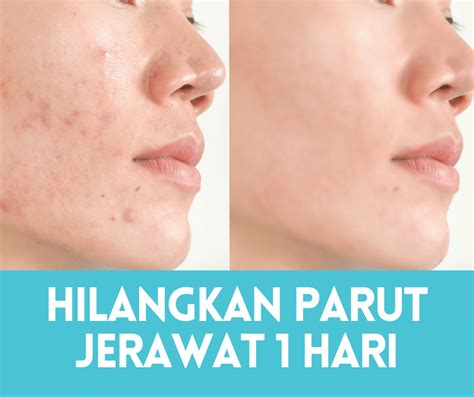 5 Langkah Mudah Untuk Jerawat Hilang dalam 7 Hari! 🤯 5 Langkah Mudah Untuk Jerawat Hilang dalam 7 Hari! 🤯