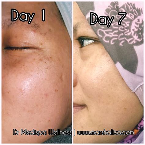 5 Fakta Mengejutkan Tentang Dermapen yang Wajib Kamu Tahu 5 Fakta Mengejutkan Tentang Dermapen yang Wajib Kamu Tahu