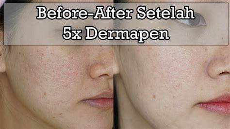 5 Fakta Mengejutkan Tentang Dermapen yang Wajib Kamu Tahu 5 Fakta Mengejutkan Tentang Dermapen yang Wajib Kamu Tahu
