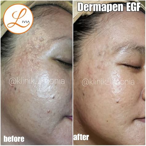 5 Fakta Mengejutkan Tentang Dermapen yang Wajib Kamu Tahu 5 Fakta Mengejutkan Tentang Dermapen yang Wajib Kamu Tahu