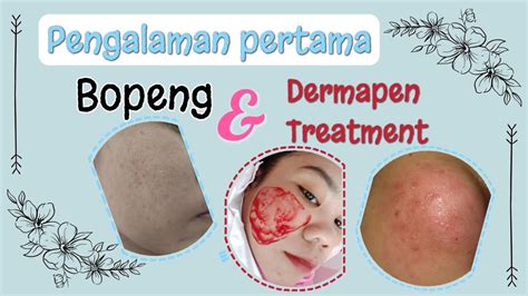 5 Fakta Mengejutkan Tentang Dermapen yang Wajib Kamu Tahu 5 Fakta Mengejutkan Tentang Dermapen yang Wajib Kamu Tahu