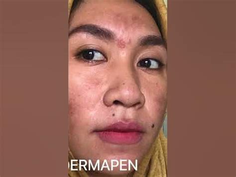5 Fakta Mengejutkan Tentang Dermapen yang Wajib Kamu Tahu 5 Fakta Mengejutkan Tentang Dermapen yang Wajib Kamu Tahu