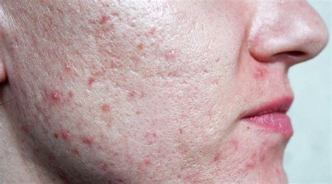 5 Fakta Mengejutkan Tentang Dermapen yang Wajib Kamu Tahu 5 Fakta Mengejutkan Tentang Dermapen yang Wajib Kamu Tahu