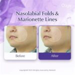 5 Treatment Terbaik Menghilangkan Garis Senyum yang Tidak Diinginkan dalam 1 Minggu!