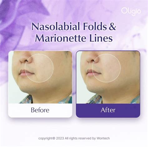 5 Treatment Terbaik Menghilangkan Garis Senyum yang Tidak Diinginkan dalam 1 Minggu! 5 Treatment Terbaik Menghilangkan Garis Senyum yang Tidak Diinginkan dalam 1 Minggu!