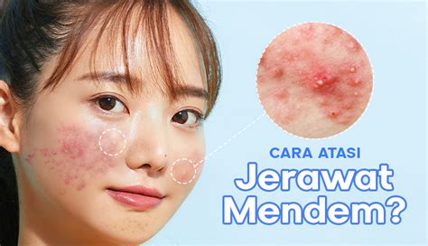 7 Cara Perawatan Wajah di Rumah yang Bisa Menghilangkan Jerawat dan Membuat Kulitmu Bersinar!
