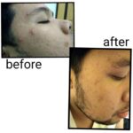 7 Langkah Singkat Basmi Jerawat Cowok: Wajah Mulus dalam 2 Minggu!
