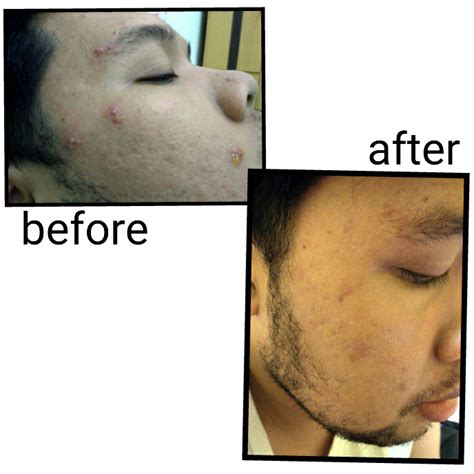 7 Langkah Singkat Basmi Jerawat Cowok: Wajah Mulus dalam 2 Minggu!