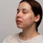 7 Rahasia Kulit Bebas Jerawat: Panduan Wajib untuk Wajah Sensitif!
