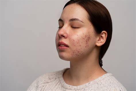 7 Rahasia Kulit Bebas Jerawat: Panduan Wajib untuk Wajah Sensitif!